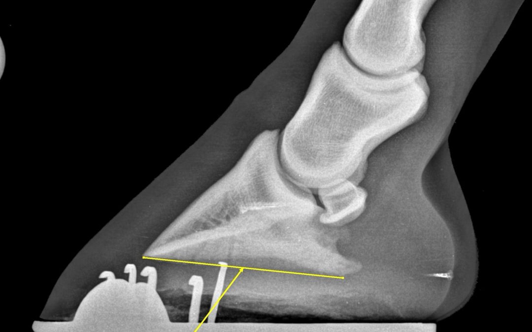 Negative Plantar Angles and Why They Matter